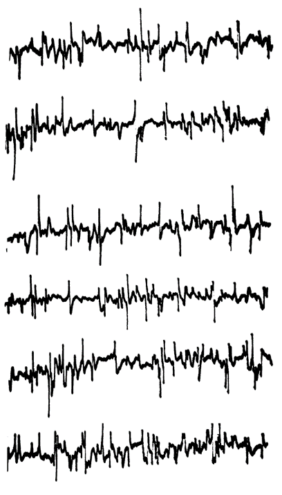 Electromyogramme montrant des potentiels de dénervation